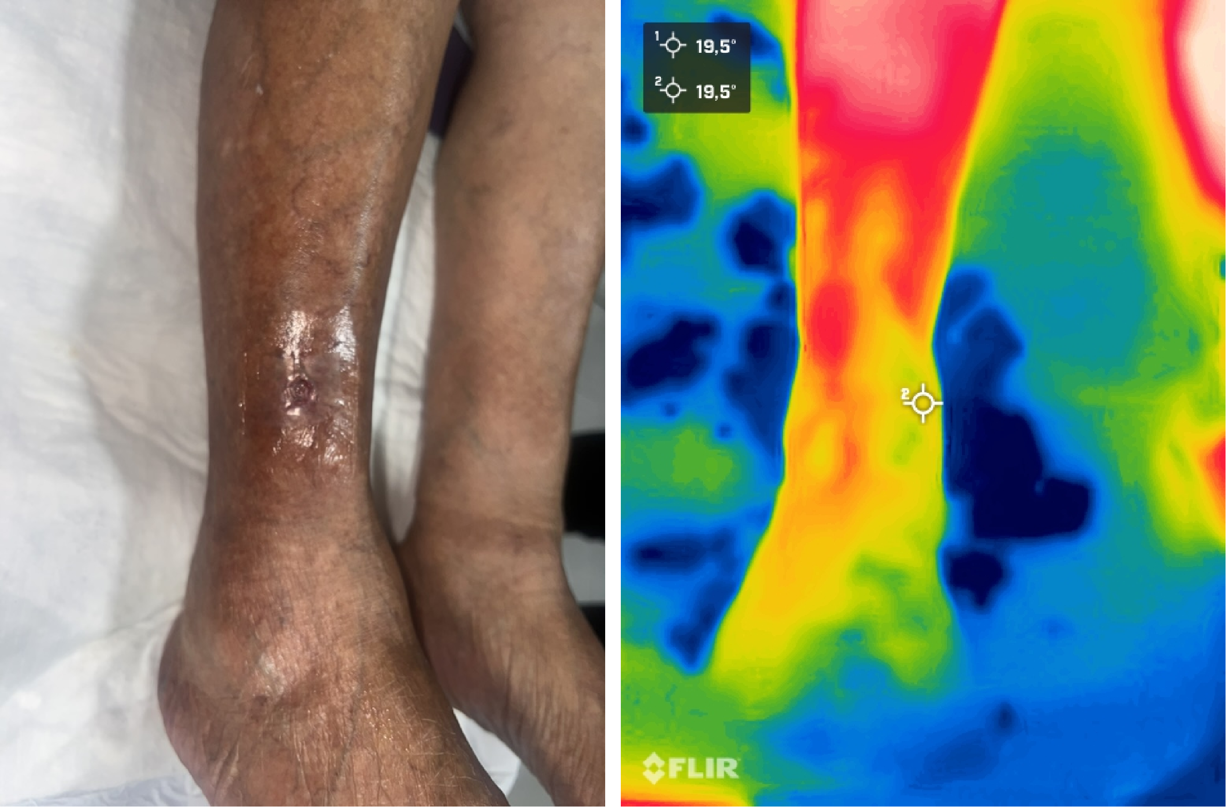 Termografía en lesiones vasculares
